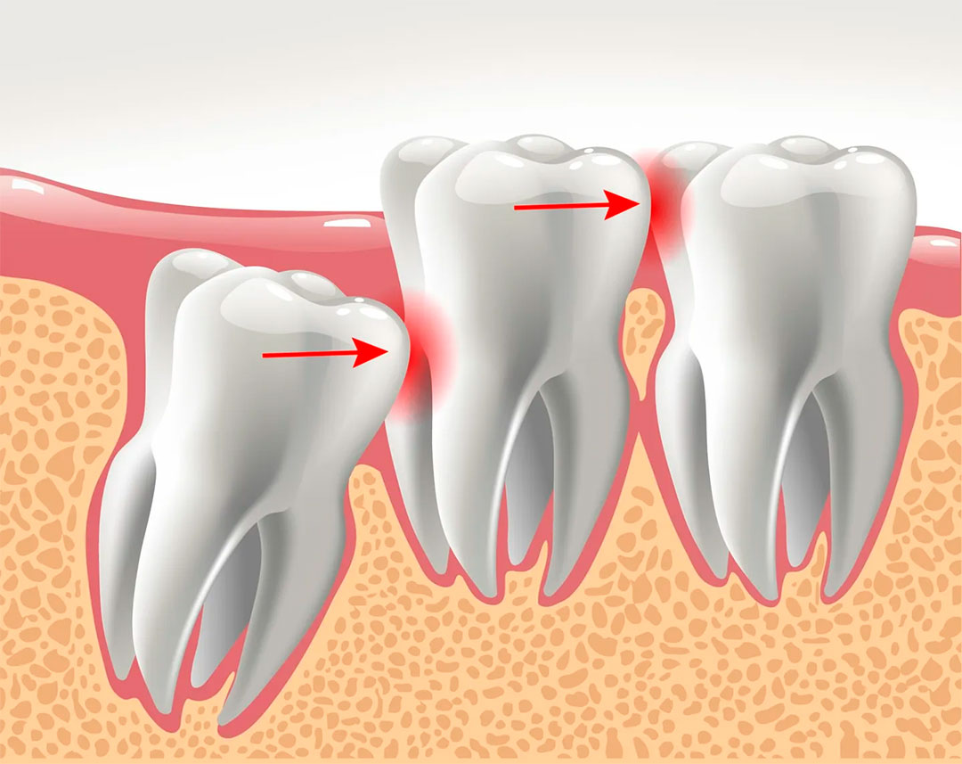 کشیدن دندان عقل ضروری است؟