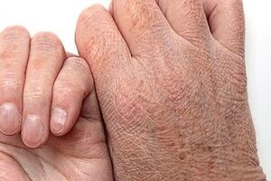 فواید سرما برای پوست