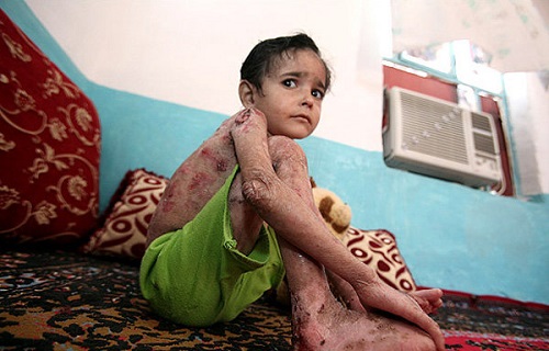 مرگ بیماران پروانه‌ای با تحریم آمریکا